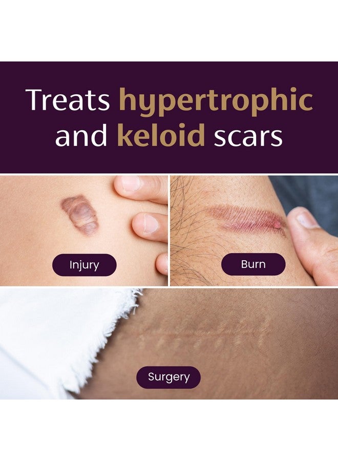 ميديرما شرائح سيليكون طبية من Mederma لعلاج الندبات؛ تعمل على تحسين مظهر الندبات القديمة والجديدة؛ لعلاج ندبات الإصابات والحروق والجراحة، 4 قطع - Image 3