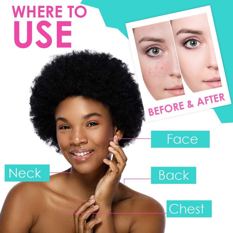 Bye Bye Blemish Acne Drying Lotion - Fast-Acting Pimple Treatment, 1oz, 3-Pack - Image 5