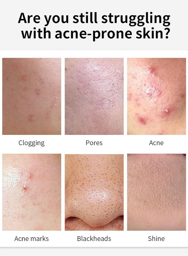 NALACAL Anti Acne Removal Cream - Acne Treatment Spot and Blackheads Treatment - Day & Night Acne Gel Set - Moisturizing Skincare Fade Acne Spots Oil Control Shrink Pores - For All Skin Types (2x30ml) - Image 4