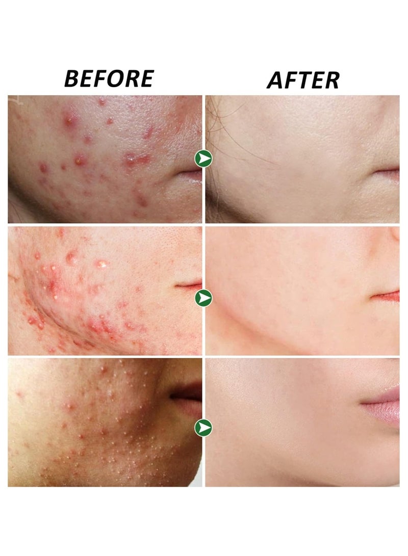 NALACAL Anti Acne Removal Cream - Acne Treatment Spot and Blackheads Treatment - Day & Night Acne Gel Set - Moisturizing Skincare Fade Acne Spots Oil Control Shrink Pores - For All Skin Types (2x30ml) - Image 5