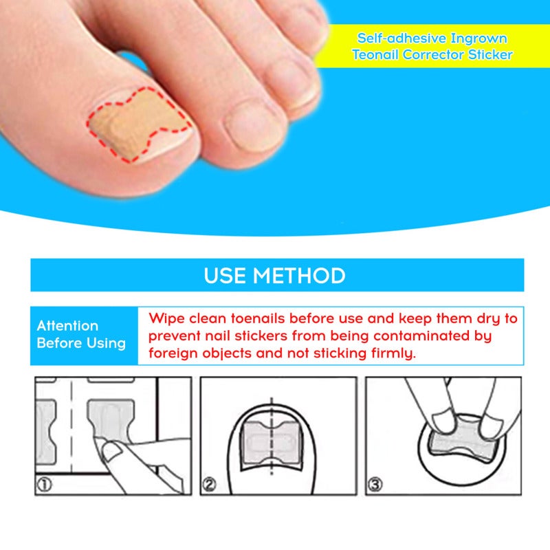 48Pcs Jelly Glue Self-adhesive Ingrown Teonail Corrector Stickers Simple Paste Daily Replacement Ingrown Teonail Corrector Tool - Image 5