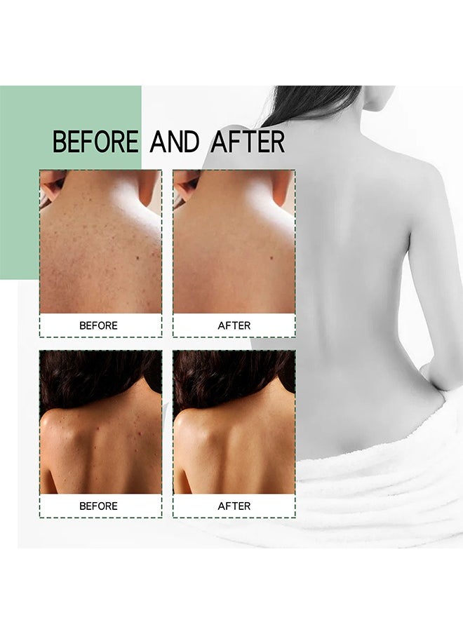 Jaysuing - Back Acne Treatment Spray , Lighten Acne Marks Repair Back Shoulder Acne Skin,2% Salicylic Acid and Tea Tree Oil Spray 120ml - Image 1