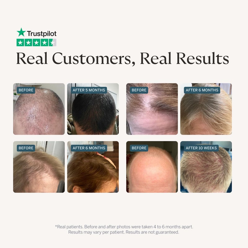 Happy Head Hair Regrowth Serum â€“ Leave-In Scalp & Hair Treatment with ProcapilÂ®, Biotin & Rosemary â€“ Lightweight Formula â€“ 2oz - Image 2