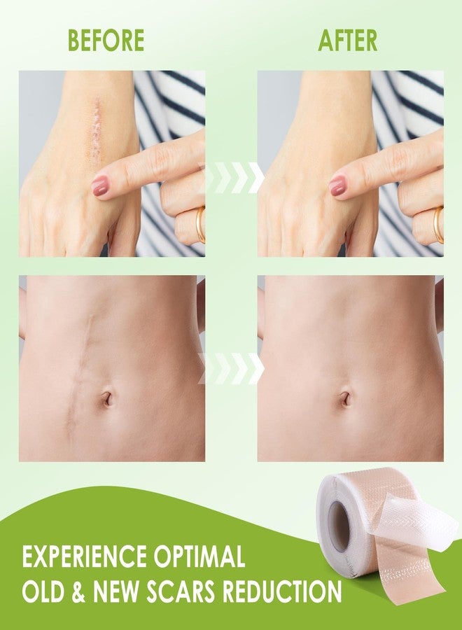 AUSLKA Silicone Scar Sheets(1.6"x 120" Roll-3M), Silicone Scar Tape, Scar Strips, Professional Silicone Scar Tape for C-Section, Tummy Tuck, Keloid, and Scar Patch - Image 2