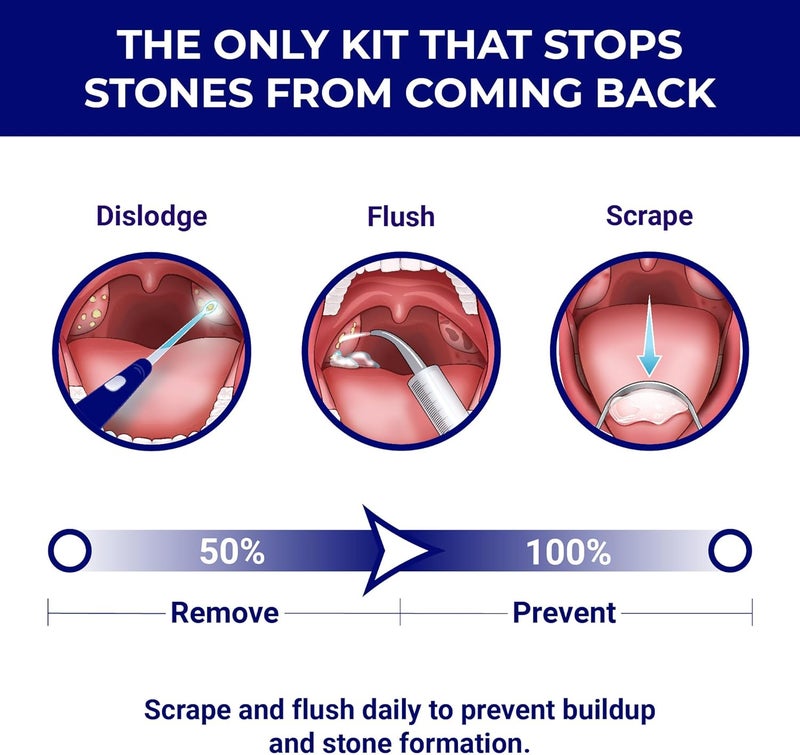 ORAVIX أداة إزالة حصوات اللوزتين من ORAVIX - مجموعة إزالة حصوات اللوزتين - أداة إزالة حصوات اللوزتين - منظف اللوزتين - مكافحة رائحة الفم الكريهة - أداة إزالة حصوات اللوزتين - جهاز غسل الفم - مكشطة اللسان - 7 قطع - Image 3