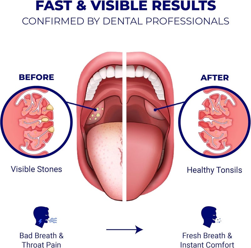 ORAVIX أداة إزالة حصوات اللوزتين من ORAVIX - مجموعة إزالة حصوات اللوزتين - أداة إزالة حصوات اللوزتين - منظف اللوزتين - مكافحة رائحة الفم الكريهة - أداة إزالة حصوات اللوزتين - جهاز غسل الفم - مكشطة اللسان - 7 قطع - Image 5