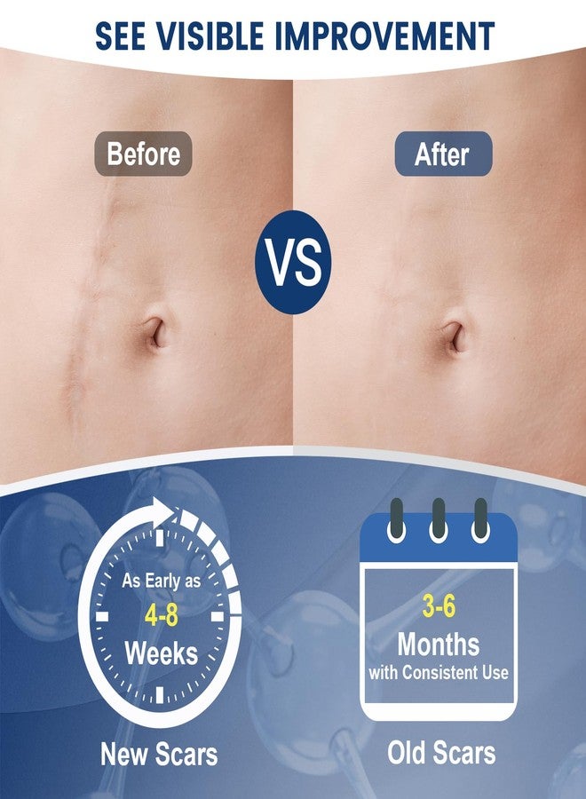 Rvlaim 100% Silicone Scar Gel Scar Cream, Advanced Silicone Gel for Removal of Surgical, Burns, Acne Scar, Old and Recent Scars and Stretch Marks, 1.7 oz/50ml - Image 4