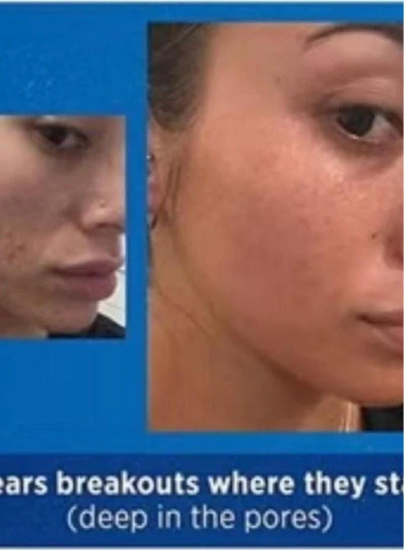 GALDERMA Retinoid Adapalene Acne Treatment Gel Multicolour 15grams - Image 3