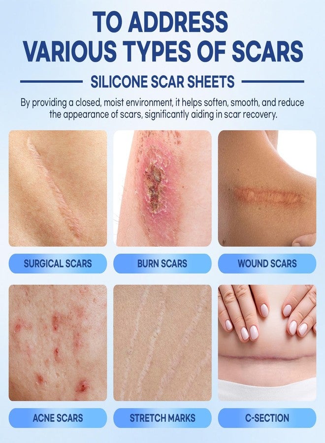 Aroamas Scar Silicone Scar Sheets – Silicone Scar Tape – 1.6"x60" for Softening and Flattening Scars, C-Section, Keloid, Surgery – Reusable & Washable – Painless Removal – 3-4 Month Supply - Image 5