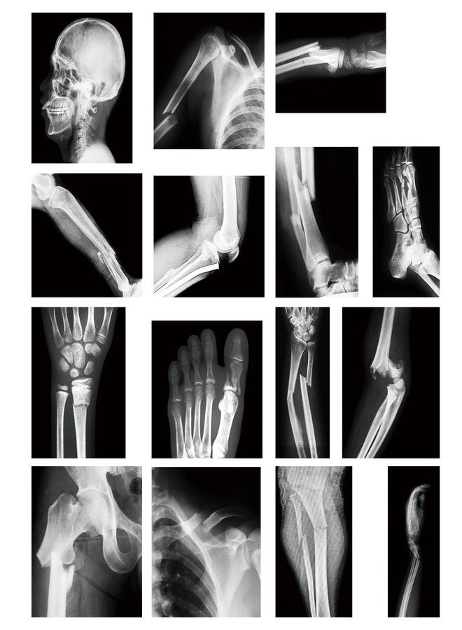 Sayglossy 15 Pcs Broken Bones x Ray Set Human x Rays Black and White Skeleton Pretend Xrays for Kids - Image 1