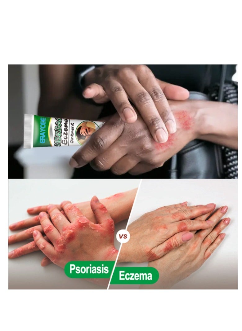 Natural Body Psoriasis Eczema Cream Ointment  Eczema Relief Body Cream, Anti Itch Back Cream Skin Care To Relieve  Suitable For All Body 20g