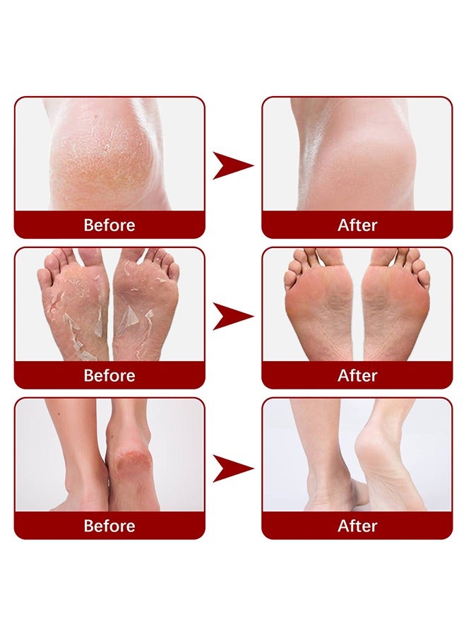 Exfoliating Foot Mask, AHA 30%+BHA 2% Peeling Solution, Moisturizing, Removes Calluses, Hydrates, Heals Cracked Dry Rough Heels, Peels Off Dead Skin 5 Pairs