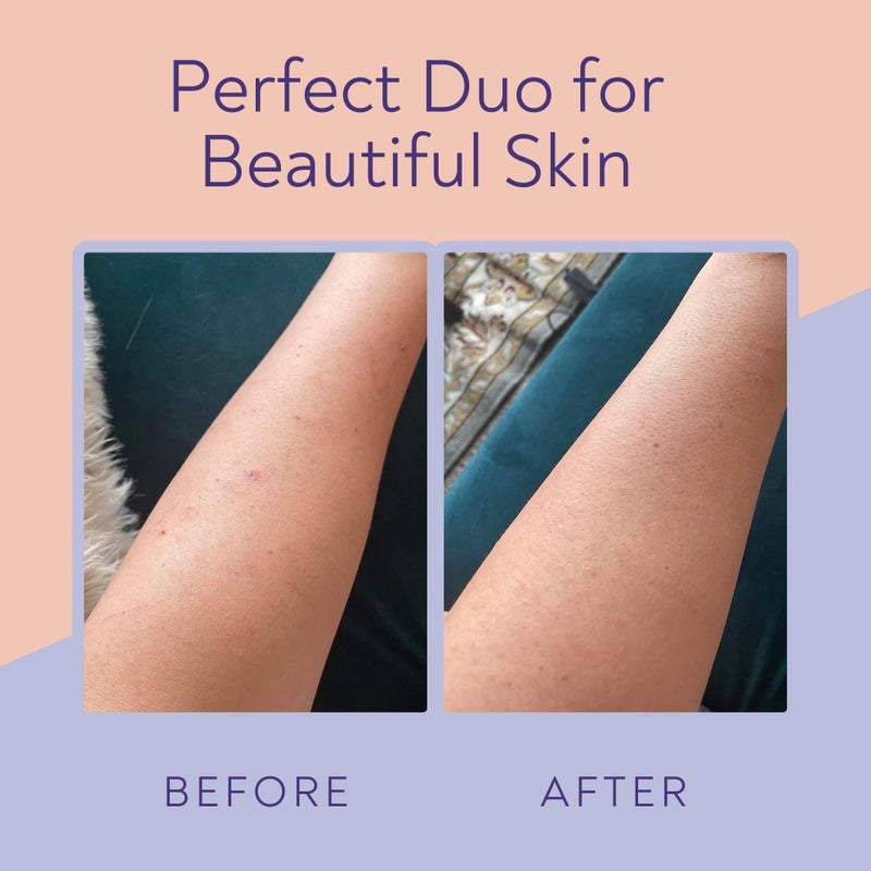 VIGORITY KP Bump Eraser Body Scrub & Keratosis Pilaris Lotion Bundle Set â€“ Strawberry Legs Treatment for Women - Exfoliates & Deeply Hydrates for Smoother Healthy-Looking Skin - Image 2