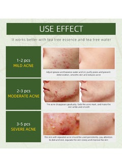 JoyPretty Herbal Acne Removing Cream- Acne Spot Treatment For Face And Acne Dots, Natural Cystic Acne Treatment, For All Skin Types, Premium Acne Scar Cream And Pimple Remover 50G  - Image 4