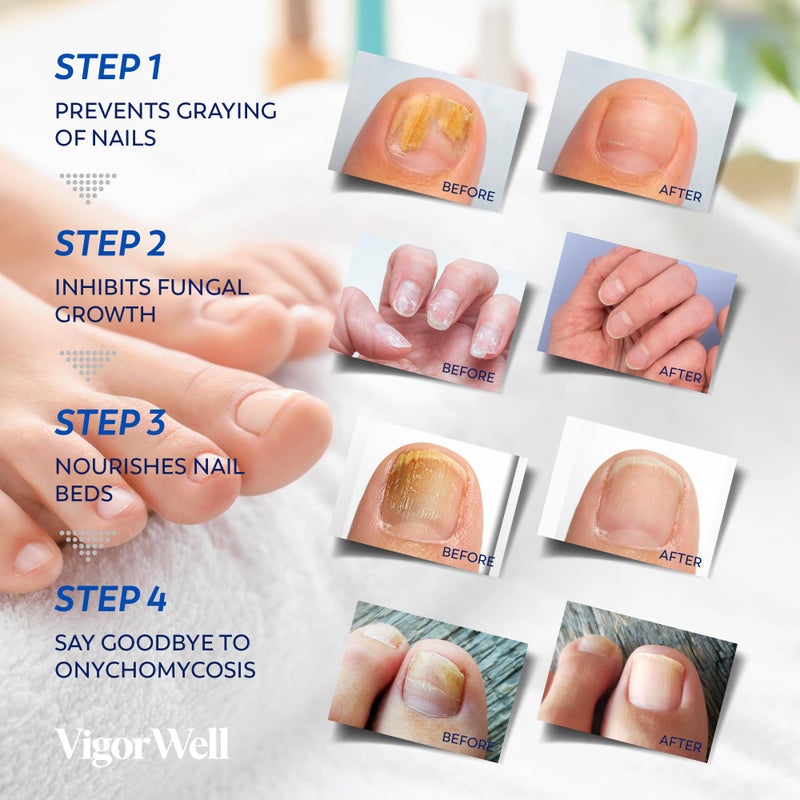 VigorWell علاج فطريات الأظافر بقوة إضافية - (متوسط) 32 لاصقة هيدروجيل ليلية لإصلاح الأظافر أثناء الليل - نتائج مرئية خلال 8 ساعات - لاصقات فطرية لتخفيف فطريات الأظافر - Image 4