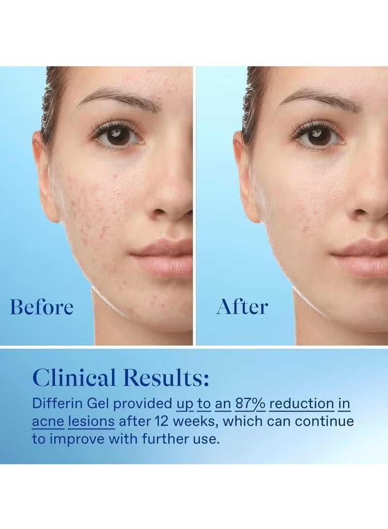 ديفرين حب الشباب هلام العلاج ، 60 يوم العرض ، تحتوي على 0.1 ٪ ادابالين الوجه حمض الريتينويك العلاج ، العناية بالبشرة لطيف للبشرة الحساسة حب الشباب ، 15G أنبوب - Image 5