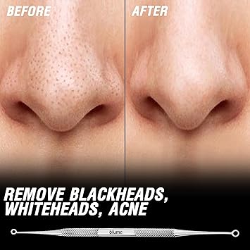 Blume أداة إزالة الرؤوس السوداء، أداة ضغط البثور، مستخرج الشوائب، أداة حب الشباب، أداة ضغط البثور، كوميدون، مزدوجة الجانب، لمسة ناعمة وغير قابلة للانزلاق للعناية بالبشرة لإزالة الرؤوس البيضاء - Image 2