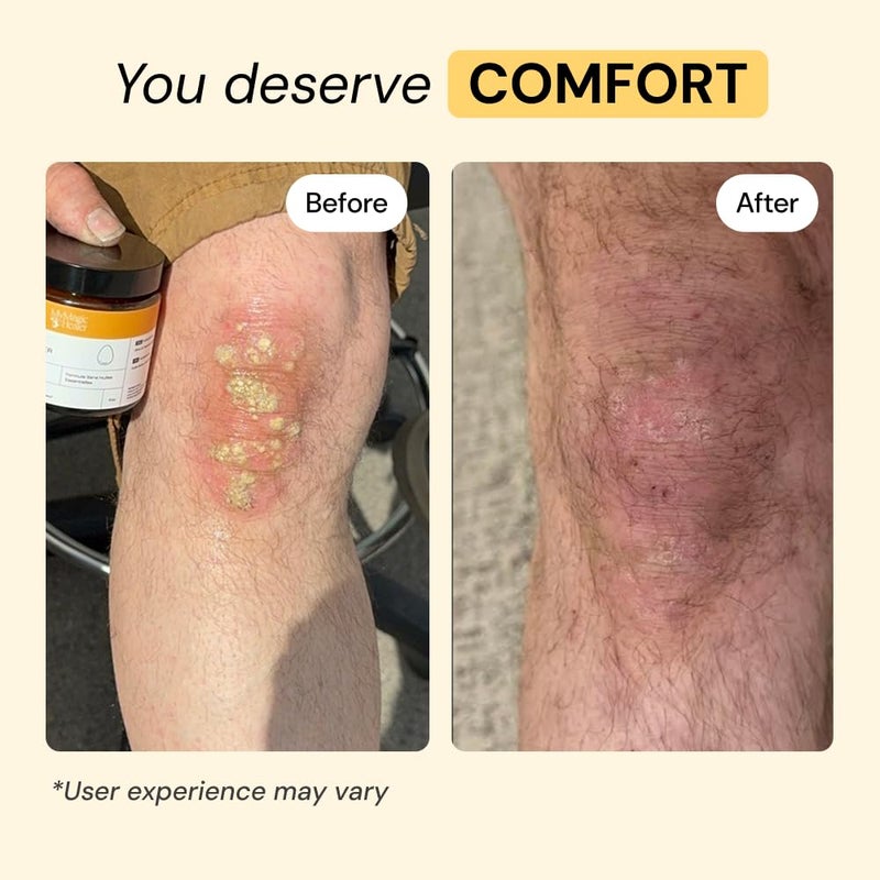 MyMagicHealer Universal Flare Care | Essential Oil Free | Baby Dermatitis, Diaper Rash, Eczema, Psoriasis, Impetigo | Wound Care | Multi-purpose Solution for Sensitive Skin w/Propolis & Egg Yolk 1 oz - Image 4