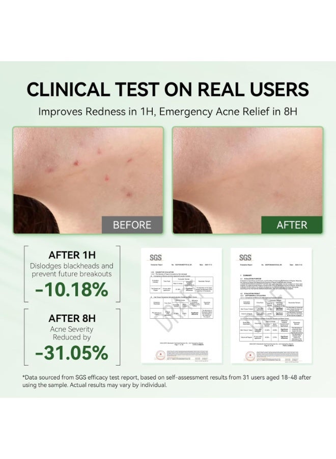 LANBENA Precision Acne Spot Serum 12ml Acne Drying Lotion Overnight Pimple Treatment with Salicylic Acid Niacinamide and Zinc Oxide - Image 2