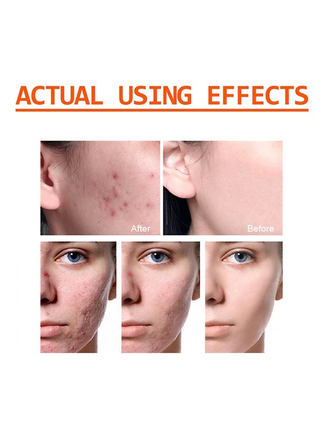 WEST MONTH Acne Face Cream 100g, Acne Spot Treatment for Face & Acne Dots, Natural Cystic Acne Treatment, For All Skin Types, Premium Acne Scar Cream & Pimple Remover - Image 3