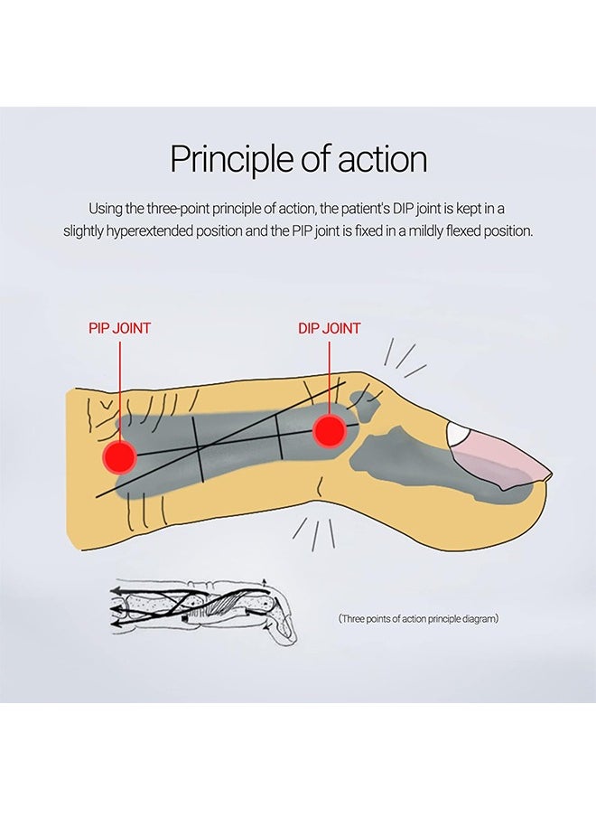 10Pcs Finger Splint, Finger Splint Mallet Finger Support Finger Splint Brace Finger Stabilizer Kit for Thumb Middle Ring Index Pinky Finger Straightener for Finger Joint 5 Sizes