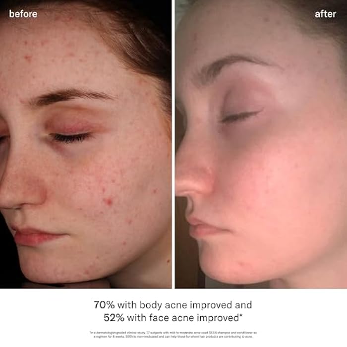 SEEN Acne-Safe Bundle - Fragrance Free- Shampoo, Conditioner & Pimple Patches – Non-Comedogenic, Dermatologist-Developed, Safe for Sensitive, Eczema & Acne-Prone Skin - Image 5