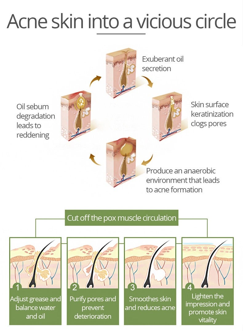AICHUN Anti-Acne Whitening Facial Serum,Salicylic ACID & Aloe Vera Extract suitable for any skin type - Image 4