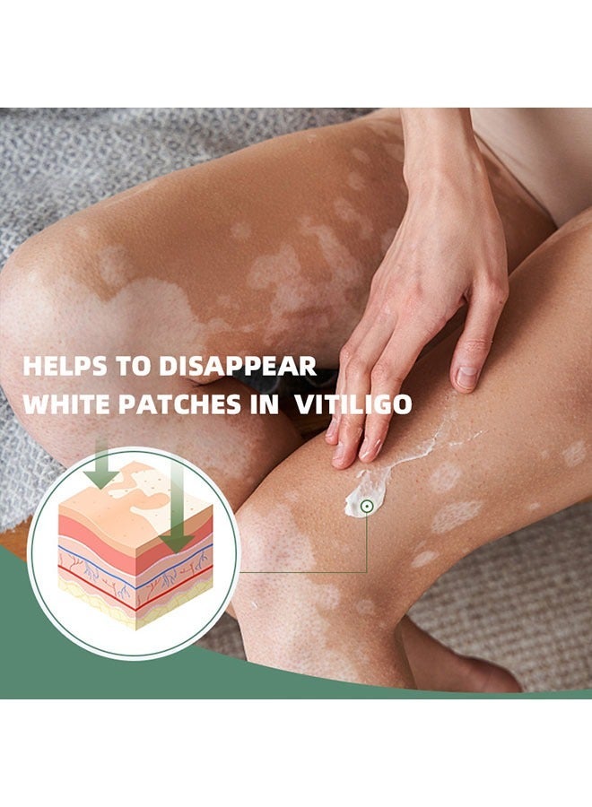 APPTRIN Vitiligo Relief Cream 20G, Treatment for Skin Vitiligo Ointment, Fade White Spot and Improve Skin Pigmentation Cream, Vitiligo Cream for Skin Healthy Care - Image 4