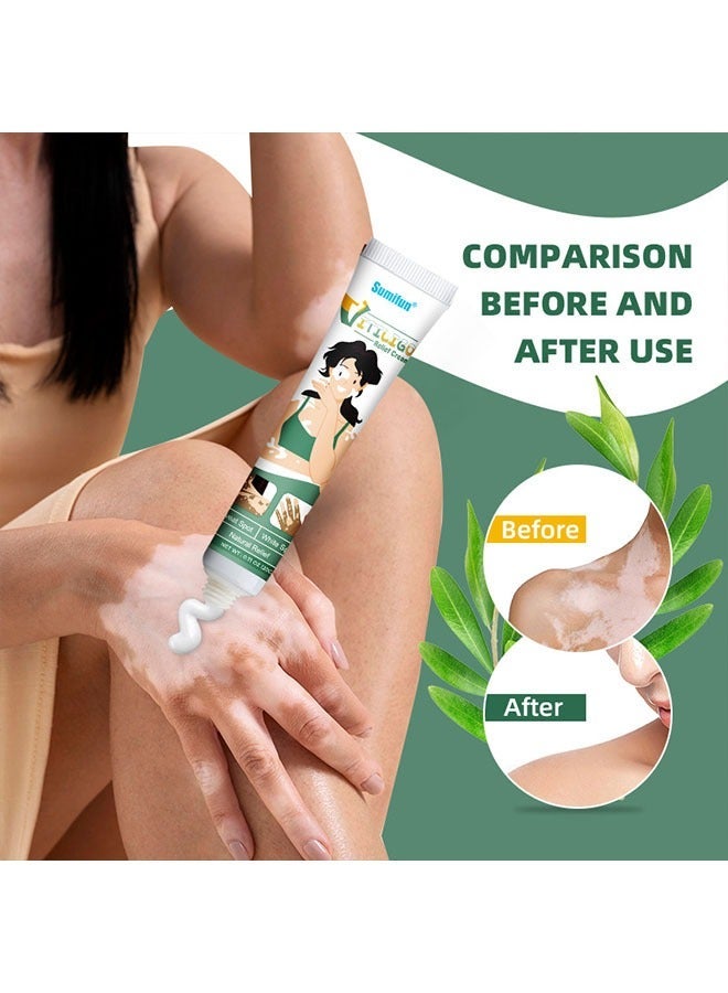 APPTRIN Vitiligo Relief Cream 20G, Treatment for Skin Vitiligo Ointment, Fade White Spot and Improve Skin Pigmentation Cream, Vitiligo Cream for Skin Healthy Care - Image 5