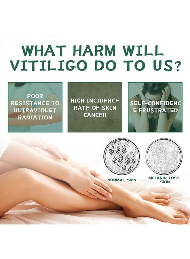 APPTRIN Vitiligo Relief Cream 20G, Treatment for Skin Vitiligo Ointment, Fade White Spot and Improve Skin Pigmentation Cream, Vitiligo Cream for Skin Healthy Care - Image 2