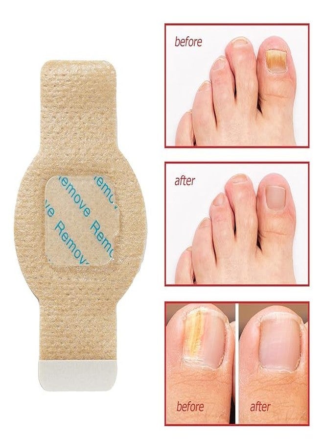 Flair Fusion New Nail Patches, 10PCS Nail Treatment Patches, Multi-Purpose Toenail Repair Treatment Pads, Toenail Patches, Antifungal Nail Treatment - Image 3