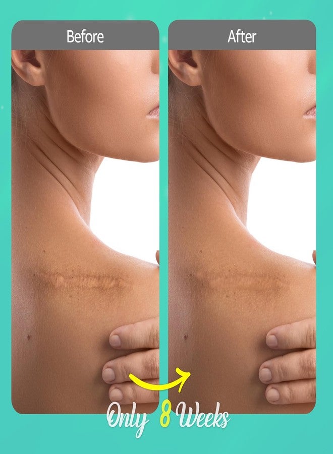 Wewell Scar Cream for Keloid Bump Removal: Professional Silicone Gel for Keloids, Acne Scars, Stretch Marks, C-Section & Burn Marks – Old & New Scar Care Treatment, 1 oz - Image 2