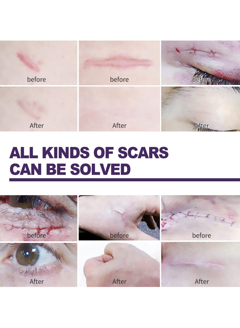 Silicone Scar Sheets, Professional Silicone Scar Tape, Gel for Scars, Soft Strips for Acne, Keloid, Burns, and C-Section Surgical Scars - Effective Scar Treatment Solution.