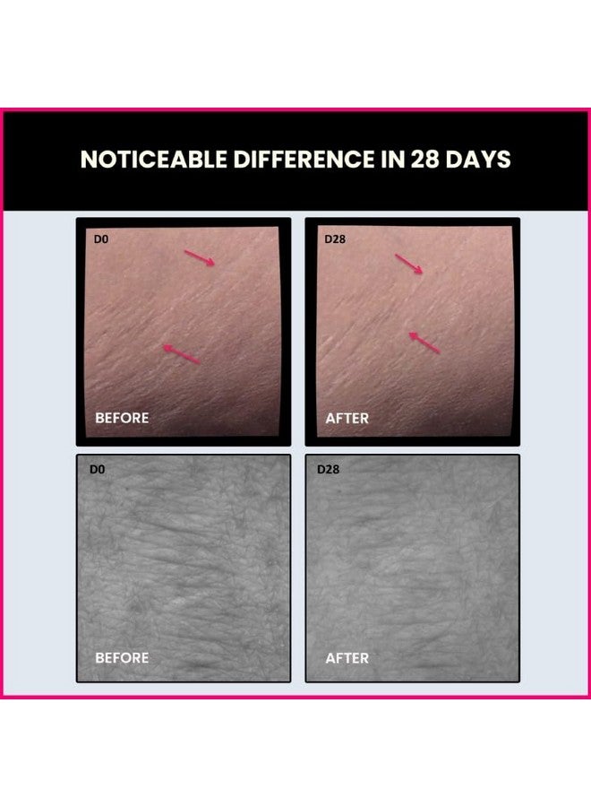 THRIVECO Stretch Marks Expert Serum Cream | Prevents & Reduces Appearance Of New (Red) And Old (White) Stretchmarks | Powered By Striover™, Rosehip Oil & Squalane | Vegan And Cruelty-Free | For Men & Women | 30Ml (Pack Of 2) 