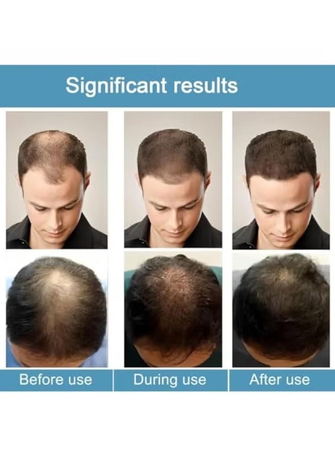 فوز اليوم Microneedle Hair, نظام إعادة نمو الشعر Alphainfuse، مصل علاج نمو الشعر المتقدم لشعر أكثر كثافة وامتلاء ، يقوي الجذور ، لطيف وغير مؤلم ، يدعم نمو الشعر الصحي للرجال والنساء (1 قطعة) - Image 4