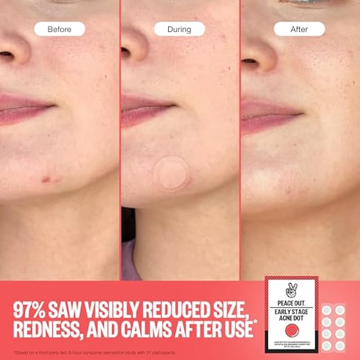 PEACE OUT Early Stage Acne Dots Helps Target Blemishes Below the Surface, Hydrocolloid Pimple Patches Minimize Bumps Before They Appear with Dissolving Microneedles, Salicylic Acid, 8 Count - Image 4