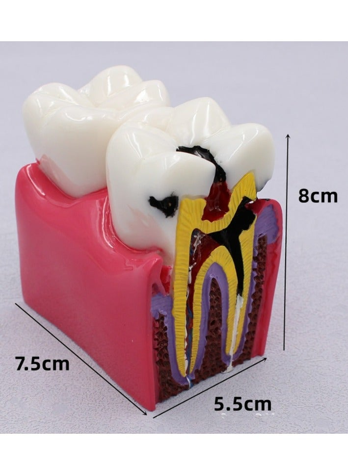 Dental Caries Teaching Model
