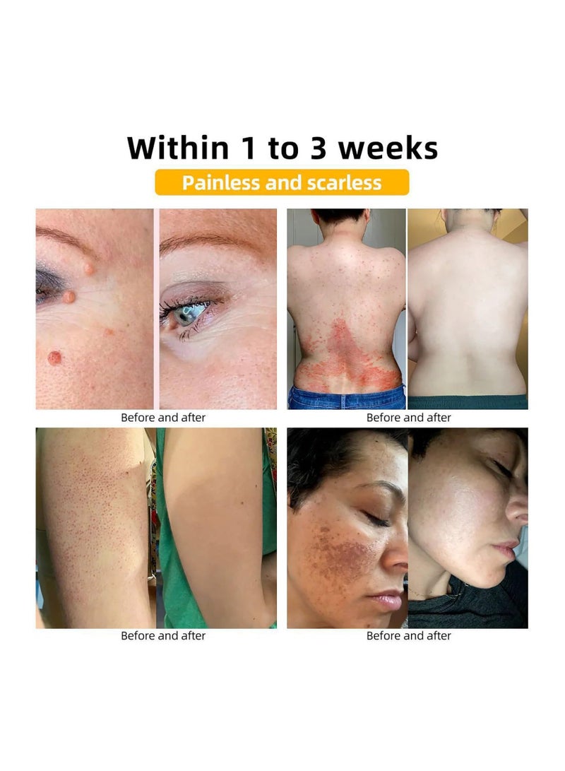 Bee Cream Wart and Tag Removal Cream, Gentle Skin Care for All Skin Types, Easy to Apply and Non-Irritating, Effective Bee Cream Solution for Warts, Skin Tags, and Blemishes, Safe Daily Use - Image 5