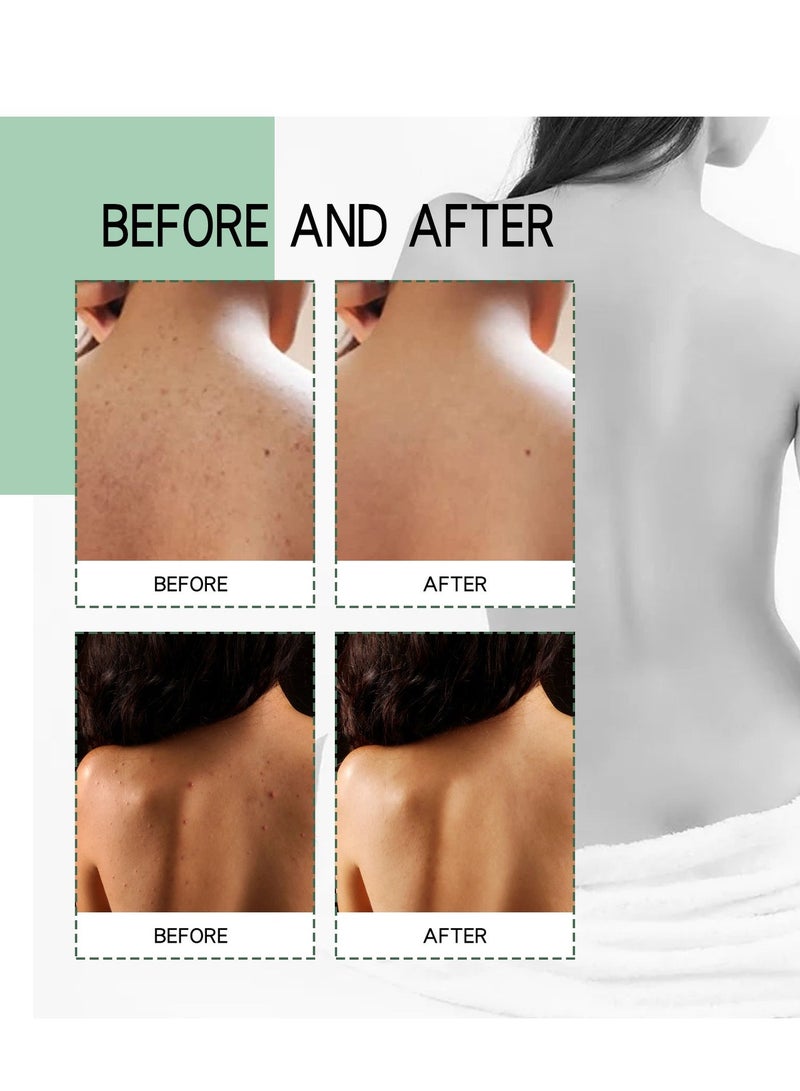 Jaysuing Back Acne Lighten Acne Marks Repair Back Shoulder Acne Skin Care spray 120ml - Image 5