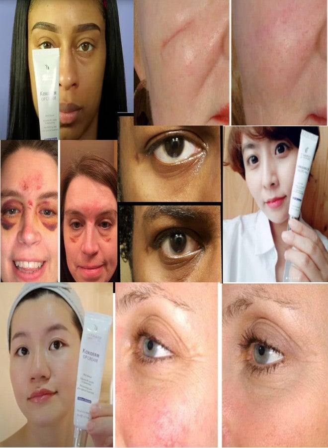 Anacis Vitamin K1 Oxiderm Cream Minimizing Appearance of Old and New Scars, Dark Eye Circles, Bruises, Varicose Veins, Purpura and Redness 1.01Oz - Image 4