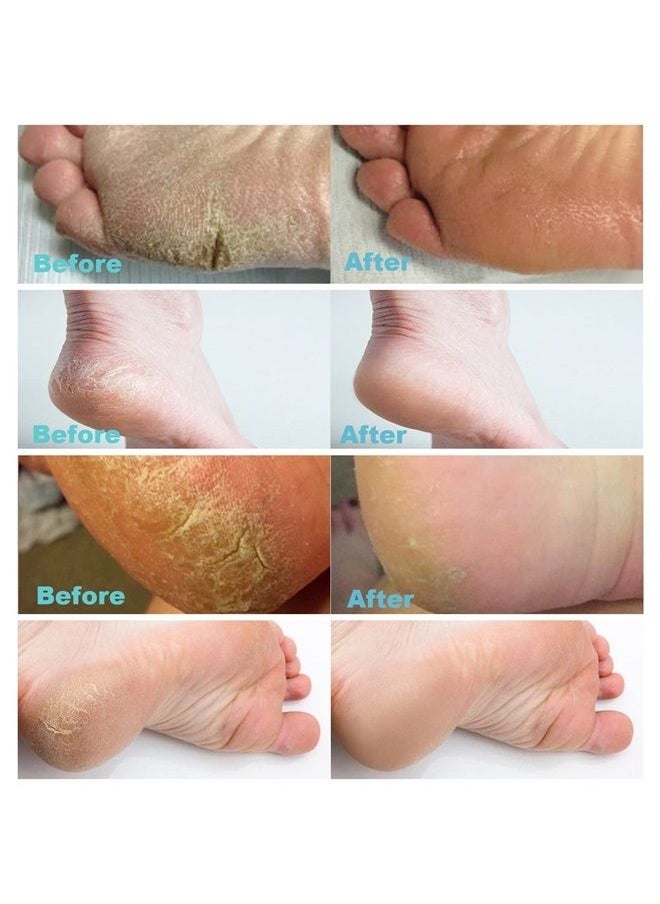 AirroYE - Urea 40% Foot Cream with 2% Plus Salicylic Acid， Foot Cream for Dry Cracked Heels - best Callus Remover For Feet & Hands, Natural Moisturizes Nourishes Softens Dry, Rough, Cracked, Dead Skin - Image 1