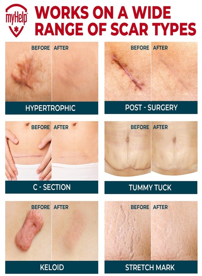 MYHELP Medical Grade Silicone Scar Tape - 1.6”x60” - Visible Difference on Surgical & Keloid Scars - Reusable Silicone Scar Sheets - Easy to Use Silicone Tape for Scars - Image 3