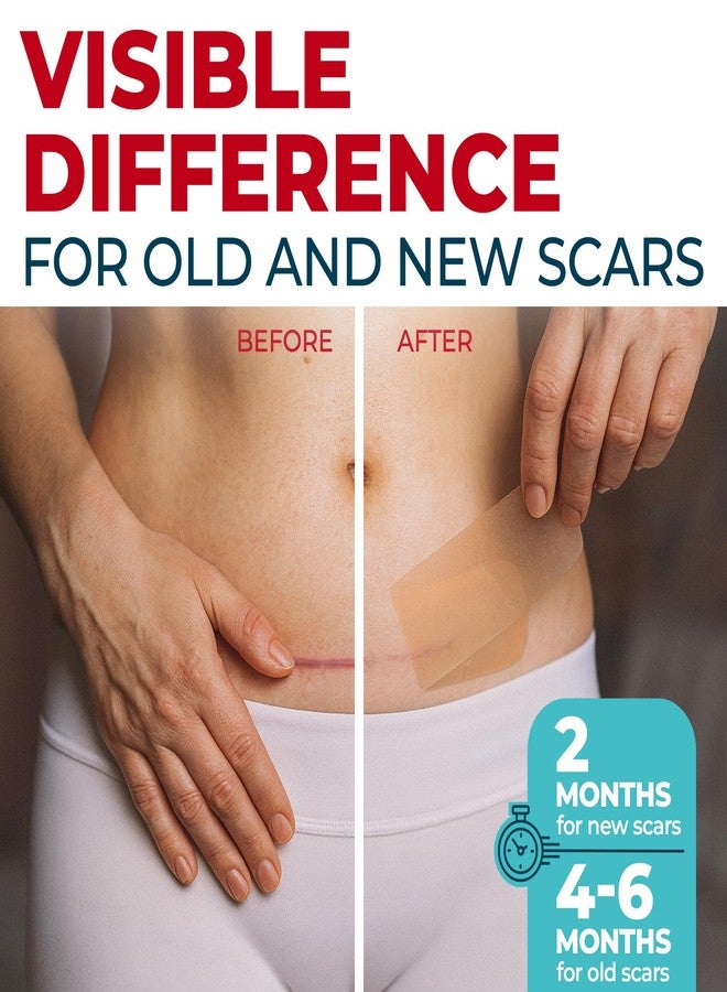 MYHELP Medical Grade Silicone Scar Tape - 1.6”x60” - Visible Difference on Surgical & Keloid Scars - Reusable Silicone Scar Sheets - Easy to Use Silicone Tape for Scars - Image 2