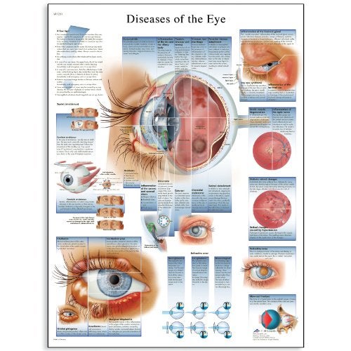 3B Scientific VR1231UU Glossy Paper Diseases of The Eye Anatomical Chart, Poster Size 20" Width x 26" Height - Image 1