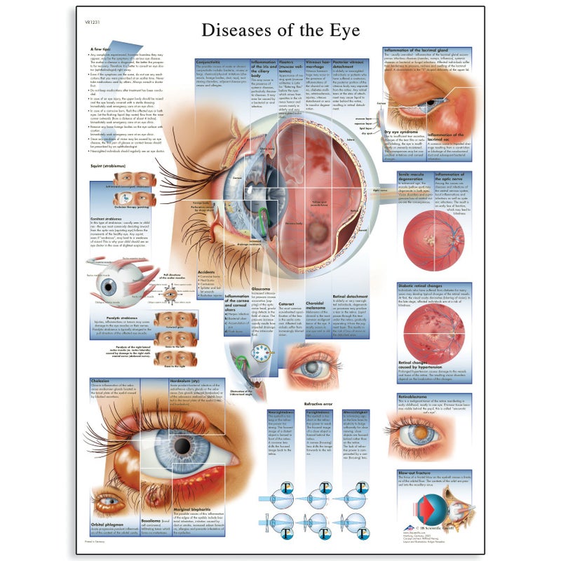 3B Scientific VR1231UU Glossy Paper Diseases of The Eye Anatomical Chart, Poster Size 20" Width x 26" Height - Image 3