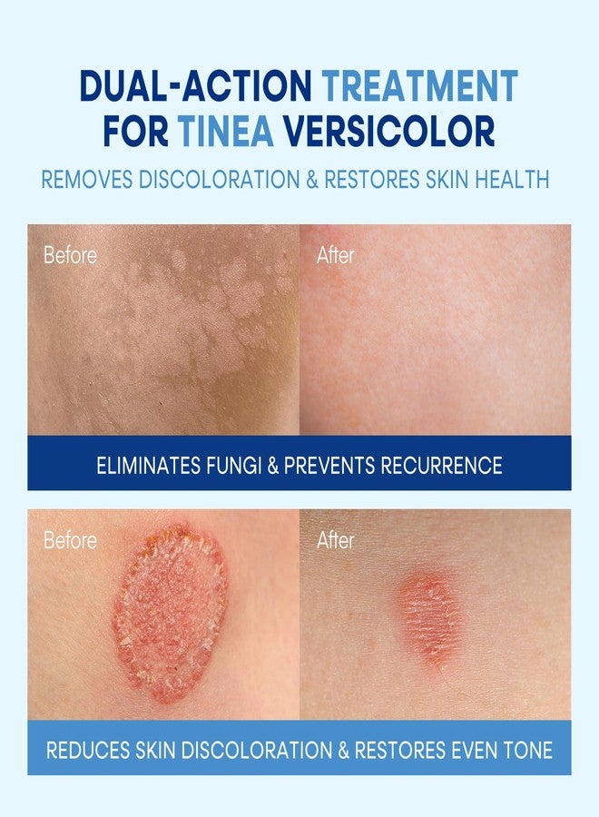 Hermon Tinea Versicolor Treatment Cream & Soap: Clinically Proven Cream for Athlete's Foot,Tinea Versicolor, Jock Itch, Ringworm - Soothes, Cleanses, and Restores Skin Health - Image 3