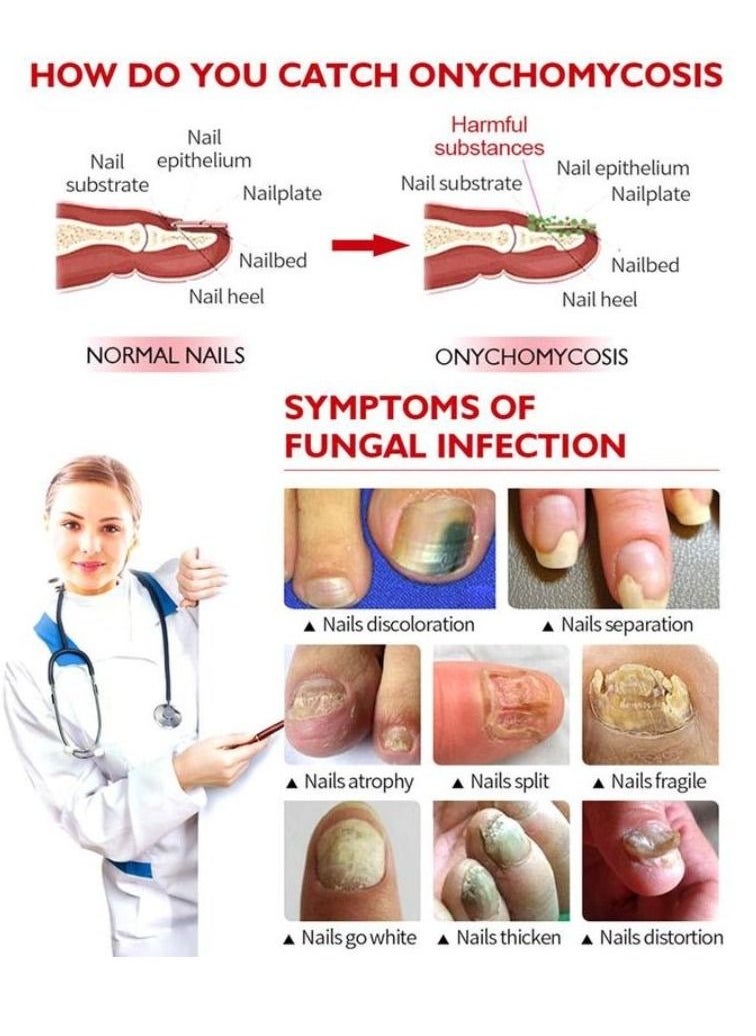 Vibrant Glamour - Professional Onychomycosis & Fungus Nail Treatment Solution - 15ml - Image 1