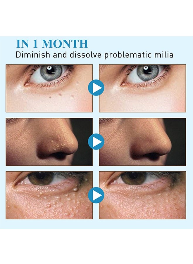 SOUTH MOON - Milia Remover Patch,Remove Fat Granule Eye Patch, Remove Oil Granule Eye Patch Under The Face, Nourish Eye Cream, Moisturize Repair and Smooth Eye Patch 144 Patch - Image 1