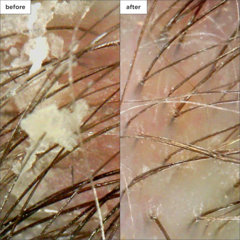 Briogeo Scalp Revival Charcoal + Coconut Oil Micro-Exfoliating Shampoo, Treatment for Dry & Itchy Scalp, Clarifying Shampoo for Build Up, Scalp Scrub for Oily Scalp, Vegan, Cruelty-Free, 8 fl oz - Image 4