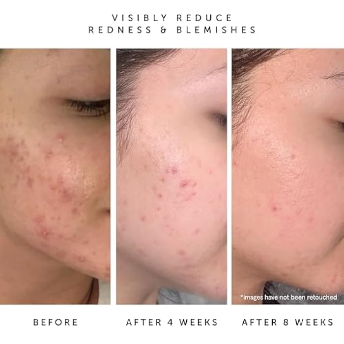 HERBIVORE Lapis Facial Oil | Balances Oil & Soothes Redness with Blue Tansy & Squalane | Safe for Oily & Acne Prone Skin, Non-Comedogenic, Vegan - Image 4